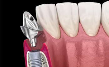 a digital illustration of an implant and the abutment