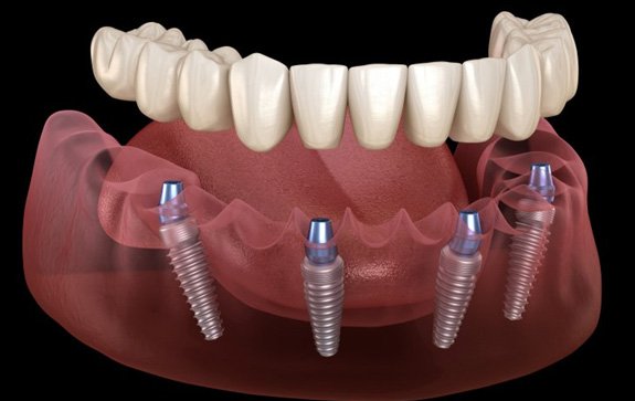 a 3 D illustration of all-on-4 dental implants