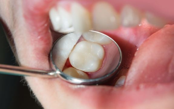 Dentist examining patient's smile after metal free dental crown restoration