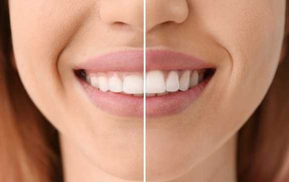 Smile before and after gum recontouring