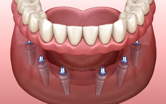A 3D illustration of an implant denture