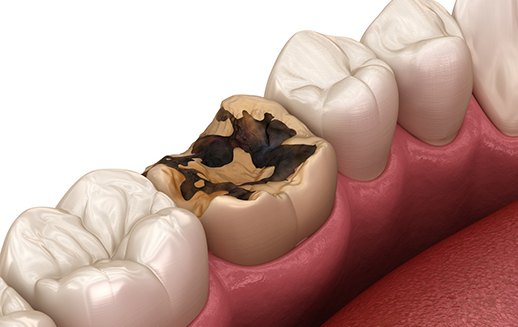 Illustration of damaged tooth that should be extracted