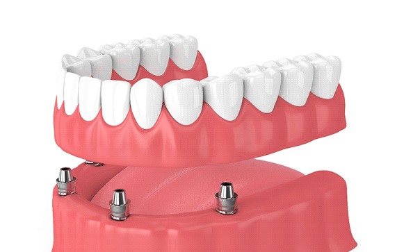 Illustration of implant dentures in Goodyear, AZ