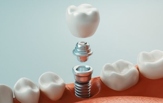 Animated smile showing the dental implant tooth replacement process