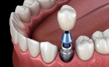 Animated tooth during dental implant supported dental crown placement
