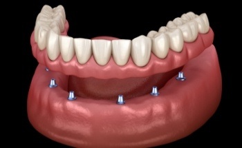 Animated smile during dental implant supported denture placement