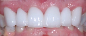 Closeup of patient's smile after dental treatment