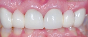 Closeup of patient's smile before dental treatment