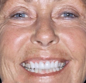Patient smiling after dental treatment