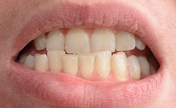 crowded teeth that require Invisalign in Goodyear