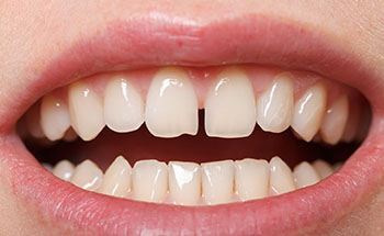 gapped teeth in need of Invisalign in Goodyear