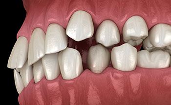 bite misalignment in need of Invisalign in Goodyear