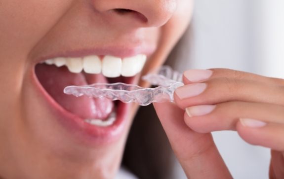 Closeup of patient placing an Invisalign clear braces tray