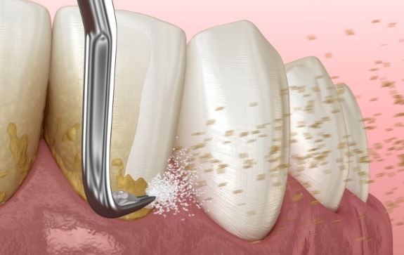 Animated smile during scaling and root planing treatment