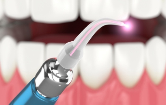 Animated smile and laser periodontal treatment tool