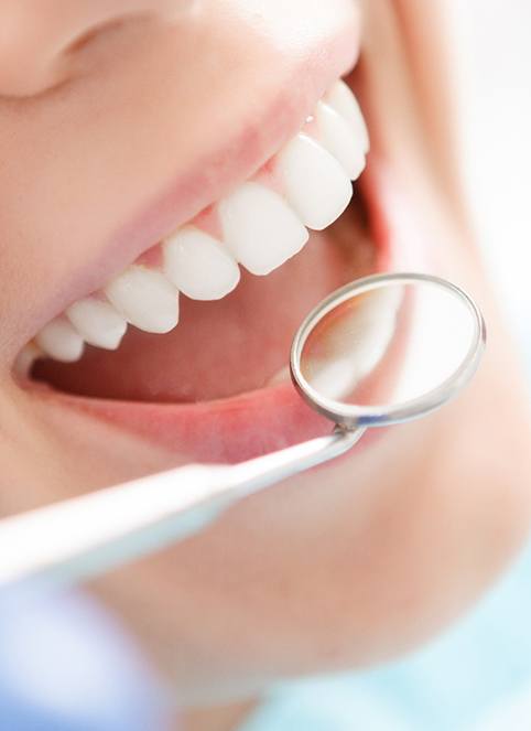 Nose to chin view of patient smiling with dental mirror