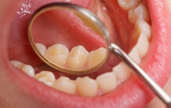 Dentist examining patient's smile after tooth colored filling treatment