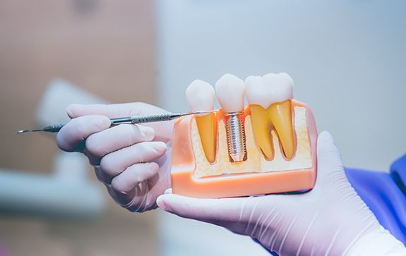 Dentist pointing to a dental implant model