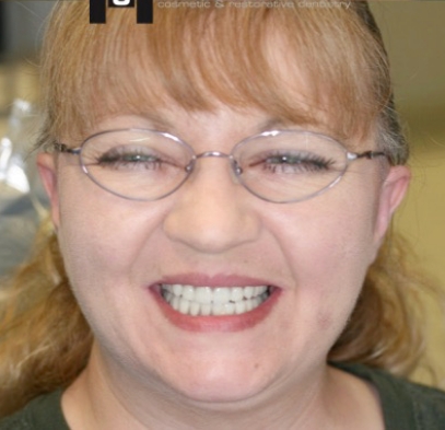 Bright white and healthy smile after treatment