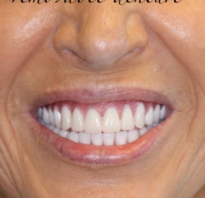 Closeup of flawless smile after gum recontouring treatment