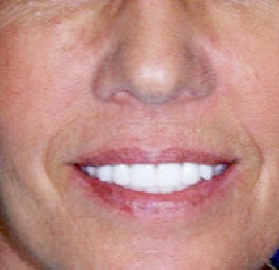 Perfected smile after orthodontic treatment