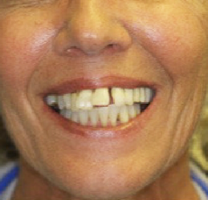 Crooked teeth before orthodontic treatment