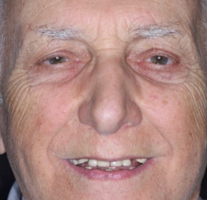 Older man with damaged and missing teeth