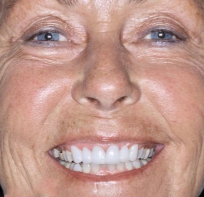 Brilliant white smile after cosmetic dentistry