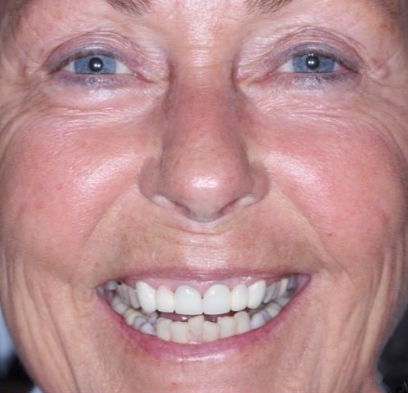 Discolored smile before cosmetic dentistry