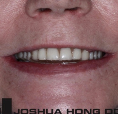 Closeup of yellowed smile before cosmetic dentistry