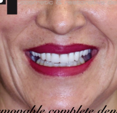 Closeup of bright smile after teeth whitening