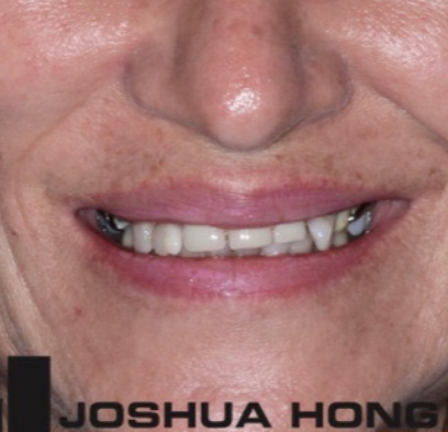 Closeup of discolored smile before teeth whitening