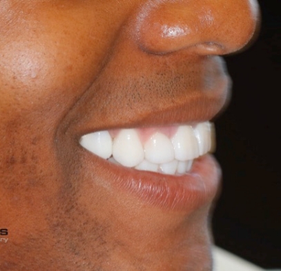 Side view of smile after gaps between teeth are closed