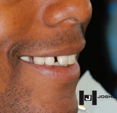 Side view of smile with gaps between teeth
