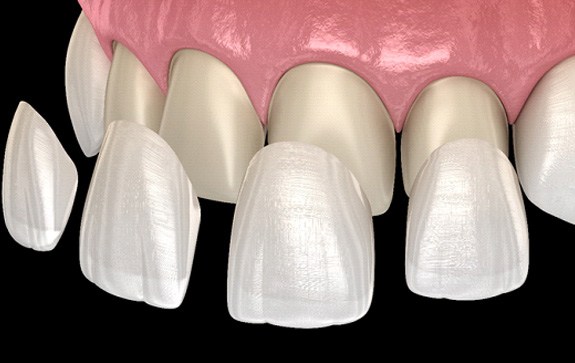 3D illustration veneers in Goodyear