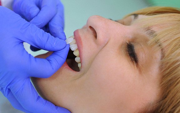 woman getting veneers in Goodyear