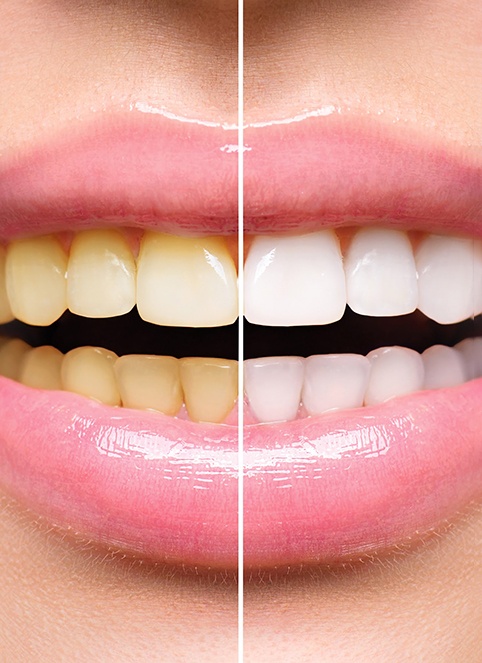 Before and after teeth whitening