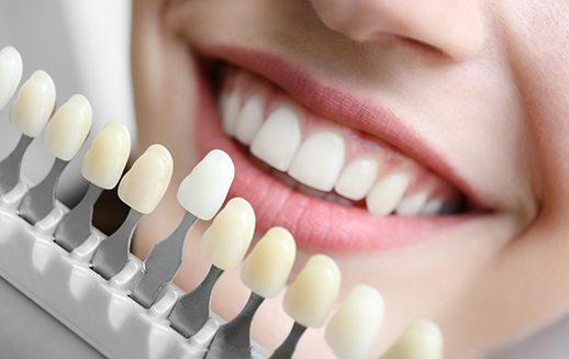 Shade guide next to woman’s teeth
