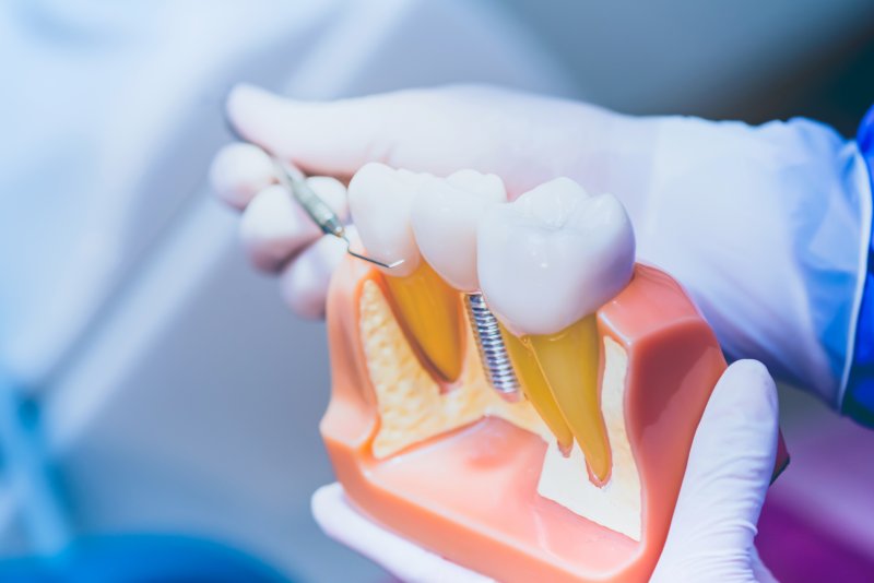 a dentist showing a model of a dental implant